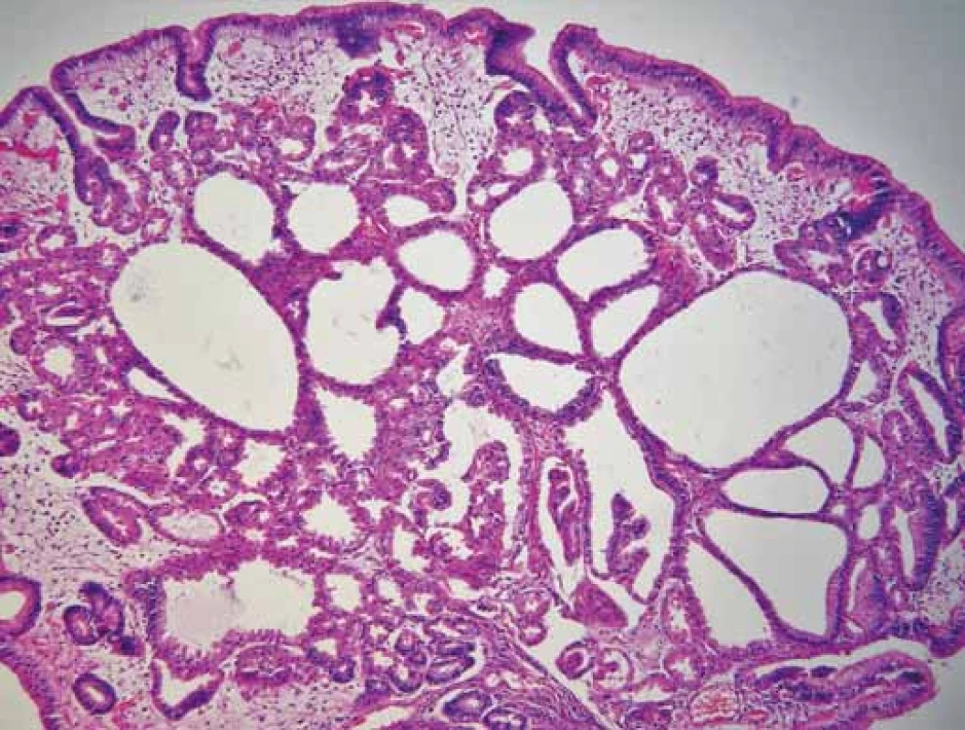 Polyp žaludku (barvení hematoxylin-eozinem,
zvětšení 100×).