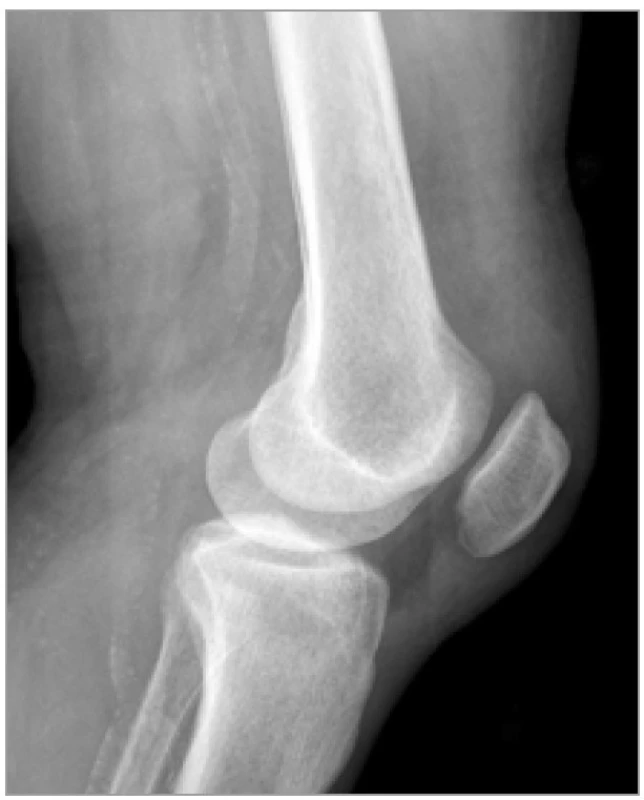 Rentgenologický snímek identického
(levého) kolenního kloubu po
úraze<br>
Fig. 2. Lateral radiography of his left
knee revealed inferior displacement of
patella