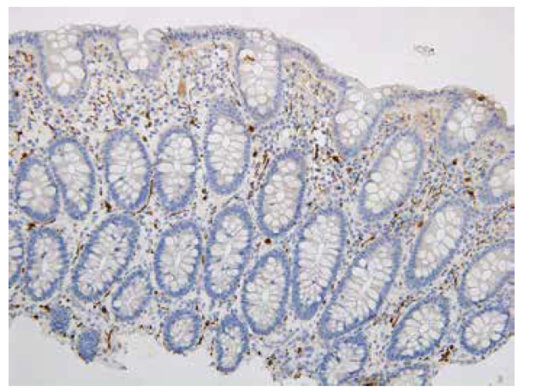 Pozitivní imunohistochemický průkaz kalretininu ve slizničních nervových
vláknech představuje normální nález, negat-HN (200x).