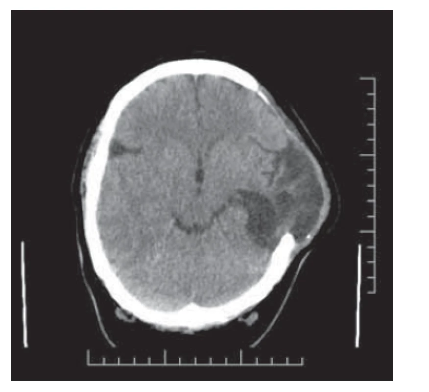 Postmalatická areřa s kompenzatorním
rozšířením postranní komory
vlevo a s okrskovitou kortikální atrofií.<br>
Fig. 2. Postmalatic area with compensatory
left ventricular enlargement
and with precarious cortical atrophy.