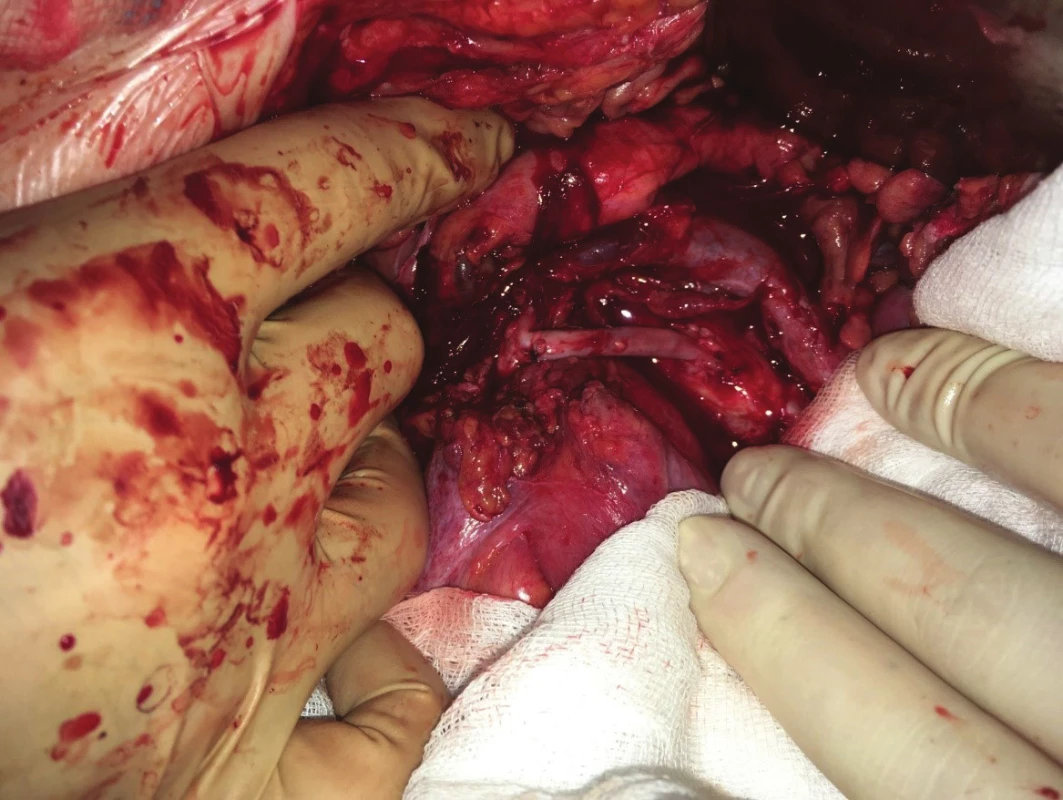 Retrográdní aorto-mezenterický žilní bypass<br>
Fig. 11: Retrograde aorto-mesenteric bypass (vein graft)