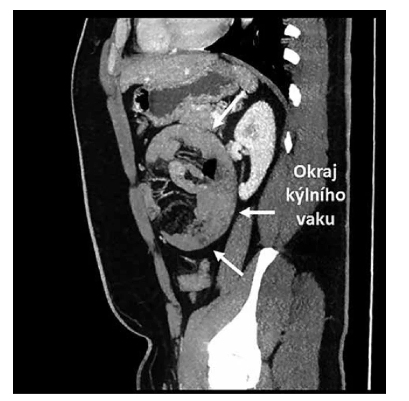 CT dutiny břišní, sagitální projekce<br>
Fig. 3: CT of abdominal cavity, sagittal projection