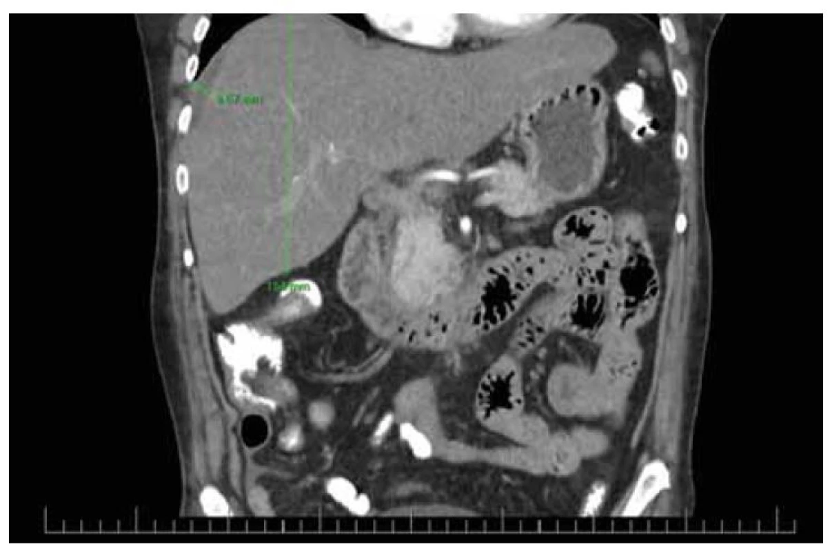 CT nález steatózy heparu s hepatomegáliou a ascitom.<br>
Fig. 4. CT finding of liver steatosis with hepatomegaly and ascites.