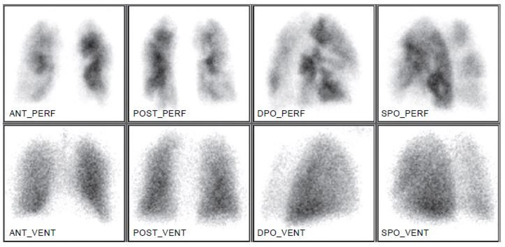 Perfuzně-ventilační plicní scintigrafie ukazuje efekt uzávěru větví plicní tepny na prokrvení plicní tkáně. Distribuce ventilace je normální.