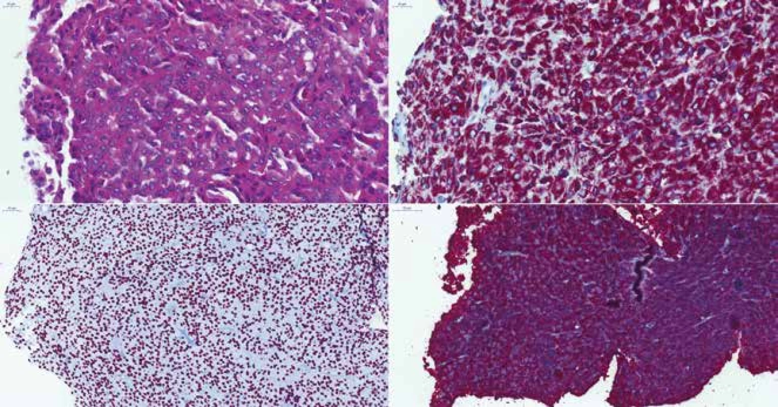 <b>(A)</b> Somatotropný „densely granulated“ makroadenóm u 39-ročnej ženy, HE 400x. <b>(B)</b> Difúzna pozitivita CAM5.2, 400x. <b>(C)</b> Expresia
transkripčného faktora Pit-1, 200x. <b>(D)</b> Difúzna silná expresia rastového hormónu, 200x.
