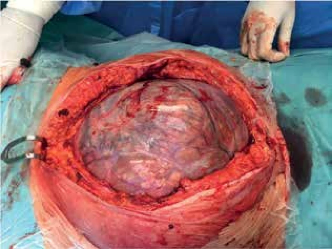 Peroperační nález<br>
Fig. 9: Peroperative finding