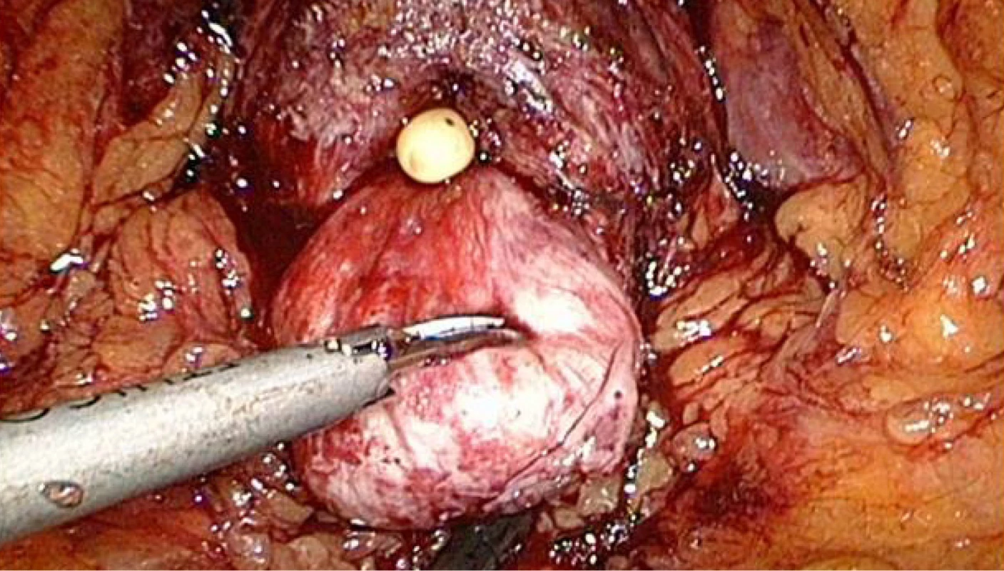 Prostata s velkým středním lalokem<br>
Fig. 4. Prostate with the large median lobe