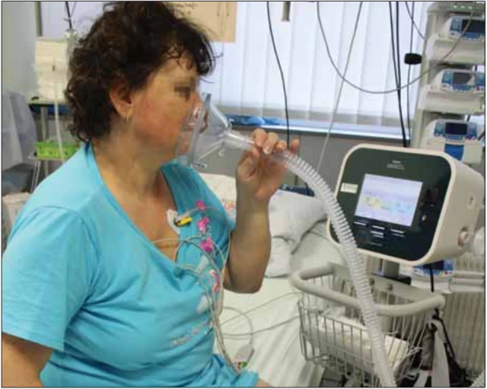 Pacientka na jednotce intenzivní péče po zaškolení samostatně používá přístroj
CoughAssist. Fotografi e byla pořízená s informovaným souhlasem pacientky.<br>
Fig. 8. Patient in the intensive care unit, after being tutored, uses the CoughAssist device
on her own. The picture was taken with informed consent from the patient.