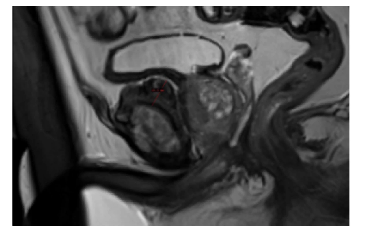 MRI, T2 vážení, sagitální řez oblastí pubické symfýzy;
měřítkem označena masivní protuberance šíře až 1,9 cm<br>
Fig. 1. MRI, T2, sagittal view through pubic symphysis;
massive pubic protuberance marked with gauge, width
up to 1.9 cm