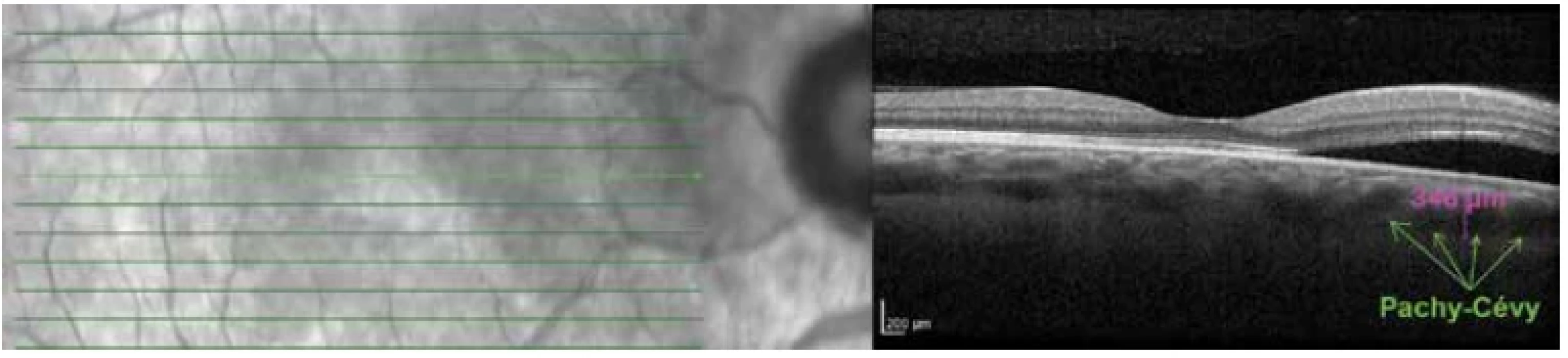Lineární horizontální transfoveolární OCT sken pravého oka: peripapilární pachychoroidní syndrom, ablace neuroretiny
v peripapilární zóně