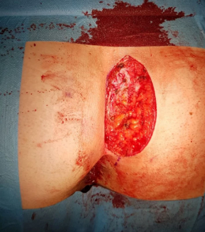 Vzniklý defekt<br>
Fig. 3: Primary defect