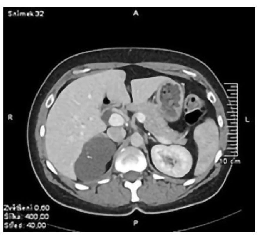 CT břicha<br>
Fig. 3. Abdomen CT