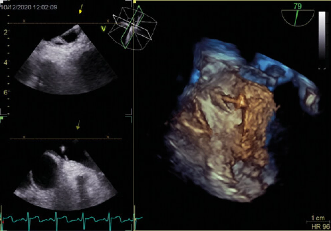 Patentní foramen ovale se zavedením vodičem (3D jícnová echokardiografie)