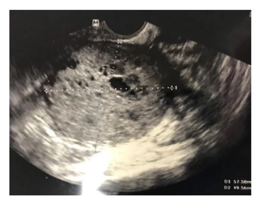 Vstupní ultrazvukové vyšetření ukazující vlevo
od dělohy solidní expanzi, místně s drobnými cystami;
zdroj: archiv ošetřujícího gynekologa<br>
Fig. 1. Initial ultrasound scan showing a solid mass
to the left of the uterus, locally with small cysts; source:
attending gynecologist’s archive