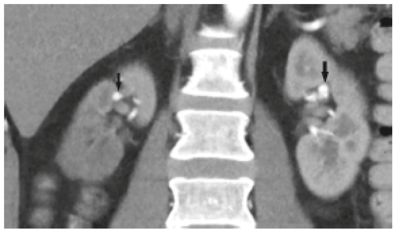 CT angiografie, arteriální fáze, koronární rovina. V obou
renálních tepnách na segmentární úrovni jsou patrná aneurysmata
(šipky). Je průkazný i asymetrický výpadek perfuze parenchymu
pravé ledviny.