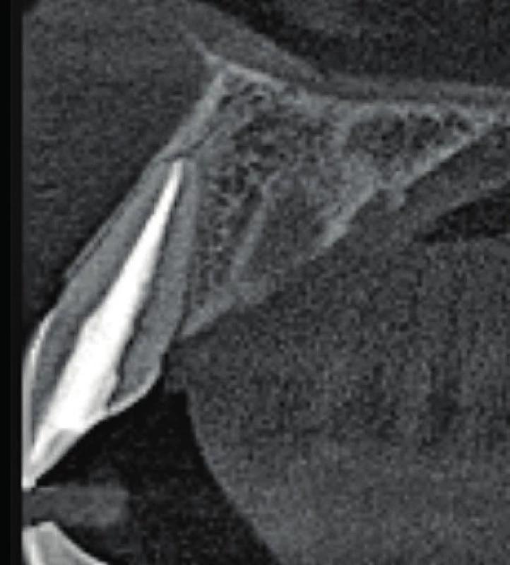 Axiální řez CBCT
snímku v místě zubu 11.
Je viditelné optimální
endodontické ošetření a
není přítomno periapikální
projasnění