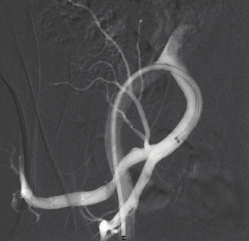 DSA – výsledek po zavedení stentgraftu (plnění
vaku aneuryzmatu není patrné)<br>
Fig. 3: DSA – outcome after the implantation of the stentgraft
(no leak of the contrast in aneurysm sac)