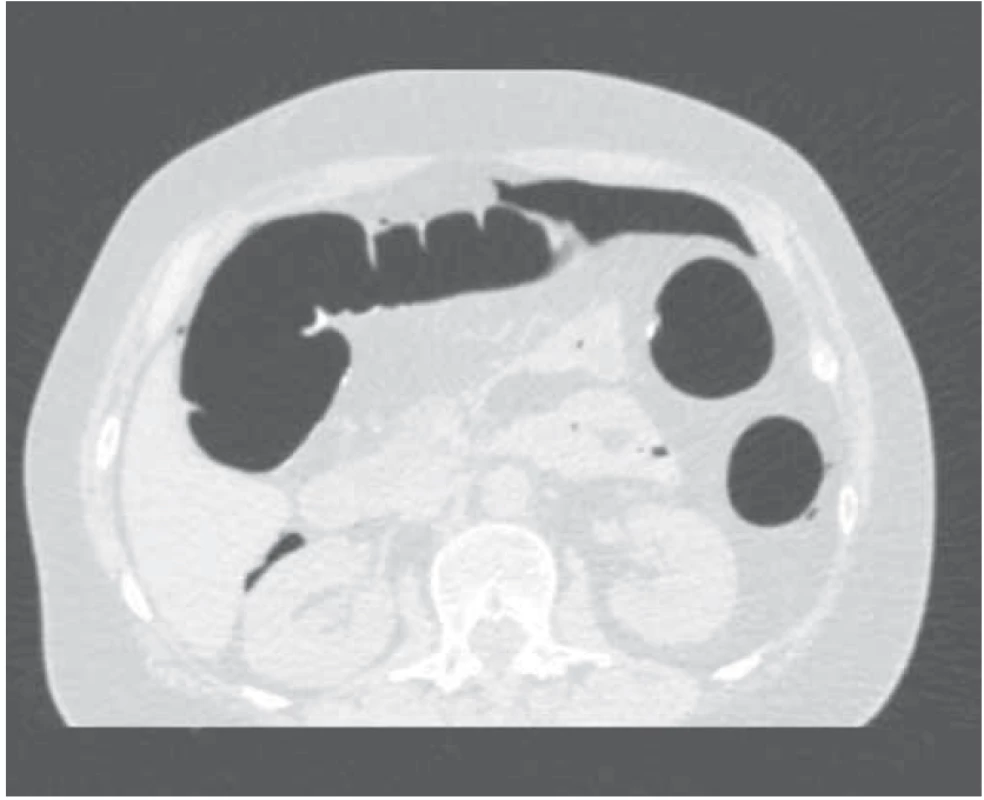 Na axiálním CT řezu, v plicním okně, patrné kolekce
volného plynu parakolicky. <br>
Fig. 2. In axial plane with lung window settings CT image
showing collection of free intraabdominal air in paracolic
region.
