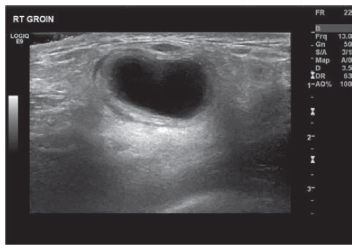 Ultrazvuk pravé kyčle zobrazující cystu<br>
Fig. 1: US right groin showing cyst