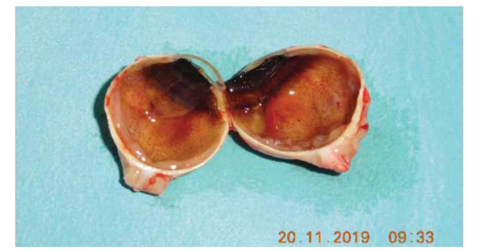 Bulbus po enukleácii: intrabulbárna masa 2x1 cm s cirkulárnym prerastaním okolo zrakového nervu