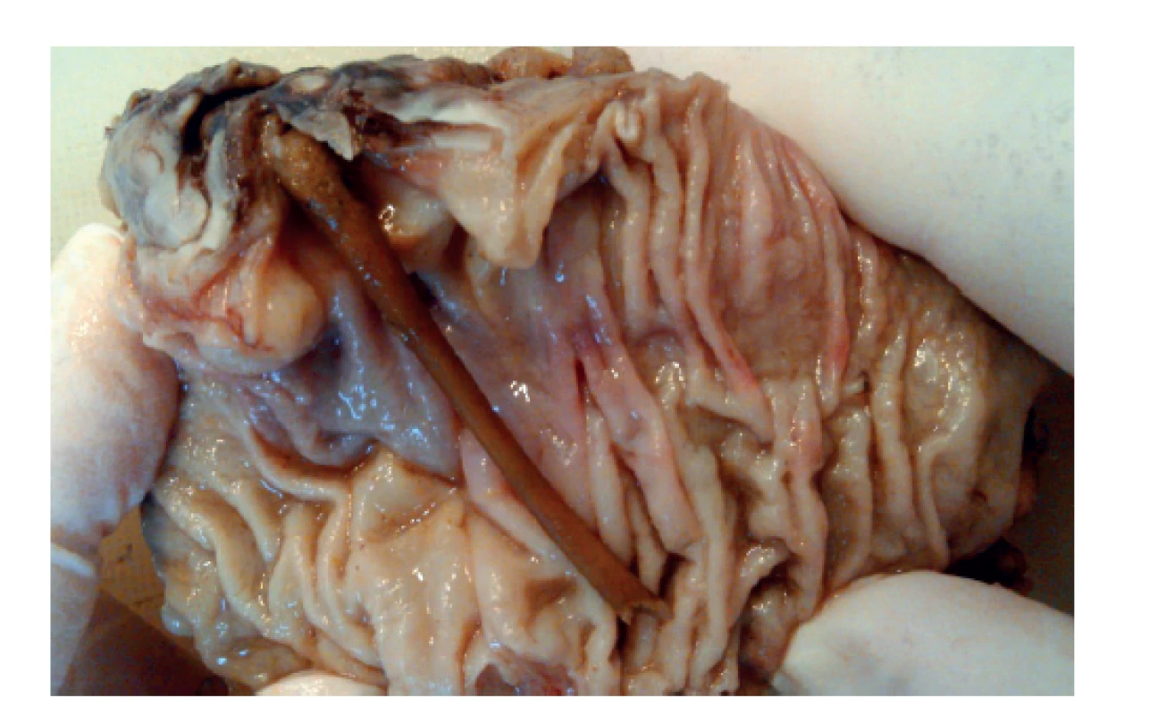 Resekát sestupného tračníku s kostí perforovaným
divertiklem<br>
Fig. 4: The specimen of the descending colon with perforated
diverticulum by bone