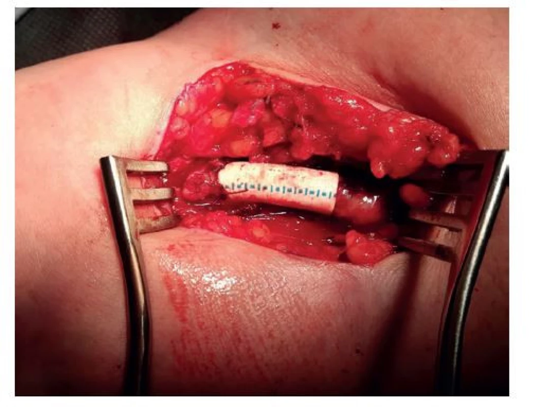 Redukce průtoku – aneurysmorafie s externí podporou
ePTFE protézou<br>
Fig. 1. Reduction of arteriovenous access blood flow –
aneurysmorrhaphy with ePTFE prosthesis as an external
support
