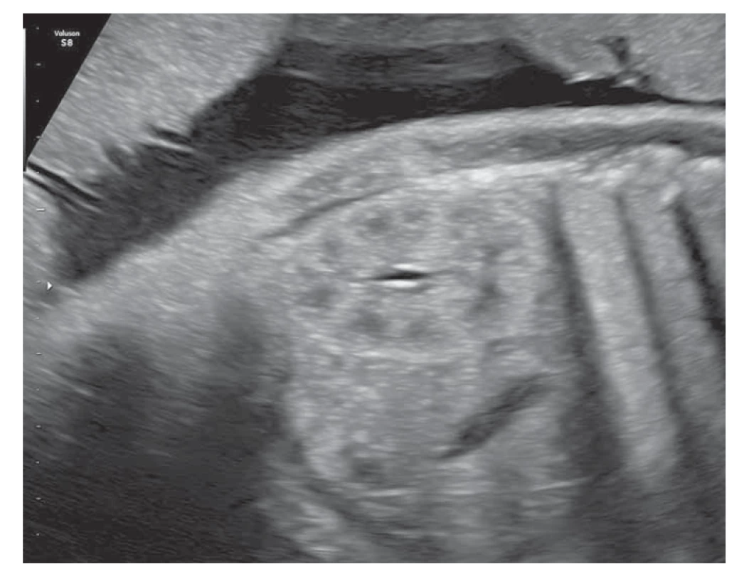 Fyziologický obraz fetálnej obličky v 31. týždni tehotnosti (foto autori).<br>
Fig. 1. Physiological picture of the fetal kidney in the 31st week of pregnancy
(photo by the authors).