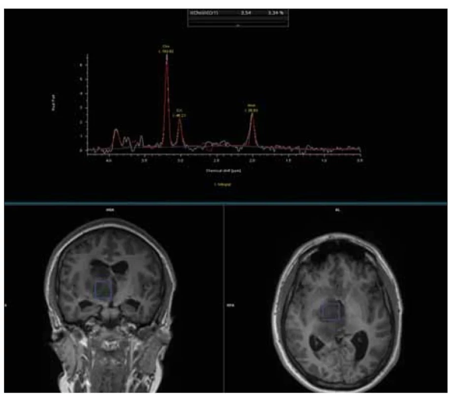 MR spektoskopie metodou jednovoxelové spektoskopie u high grade gliomu.<br>
Fig. 7. MR spectroscopy by single-voxel spectroscopy method in high-grade glioma.