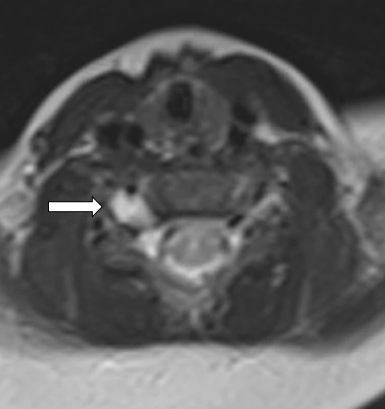 MRI – 2D T2 vážený obraz, axiální rovina v úrovni disku C5–6. Hypersignální pseudomeningocele foraminálně C5–6 vpravo.<br>
Fig. 6. MRI – 2D T2 weighted image, axial plane. Hyperintense pseudomeningocele at the level of right C5–6 neural foramen.