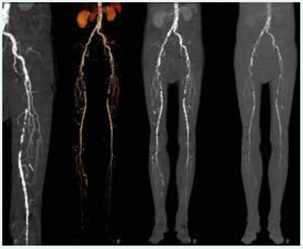Aterosklerotické postižení tepen dolních
končetin při CT angiografii