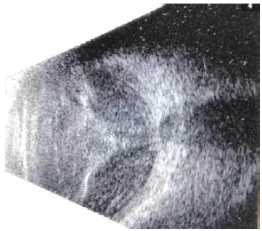 B-scan demonstrated a near-kissing suprachoroidal
hemorrhage