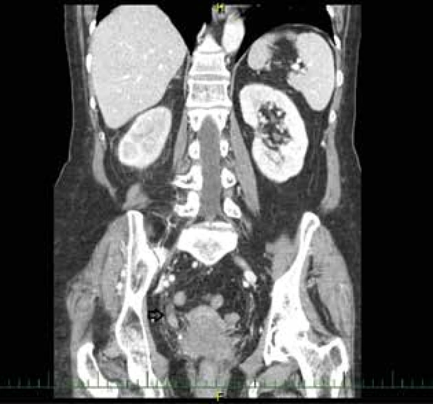 Uroteliální karcinom distálního močovodu, vpravo – CT<br>
Fig. 1: Urothelial carcinoma of the distal ureter, right – CT