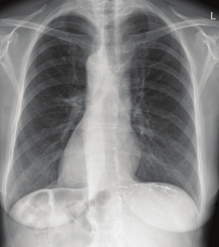 Postoperative chest X-ray showing dextrocardia
(thus complete situs inversus)<br>
Note the hemoclips at the resection plane of the liver under
the left portion of the diaphragm.