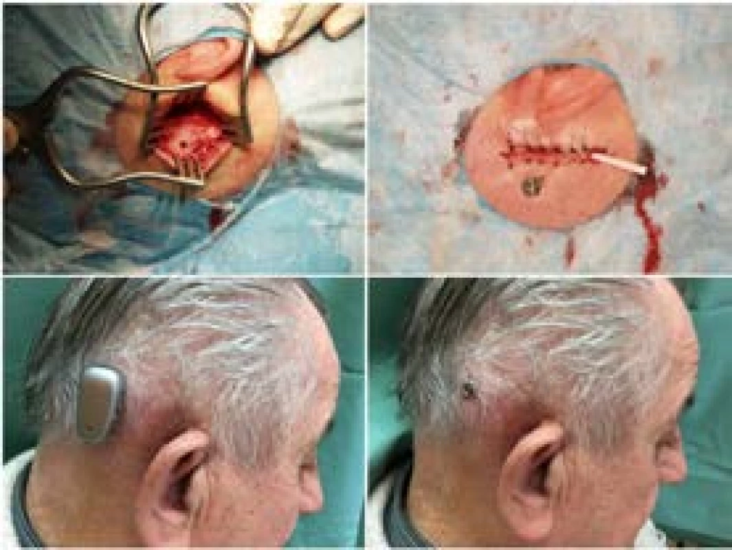 Implantace systému BAHA Connect (zdroj: archiv KOCHHK
FNUSA)