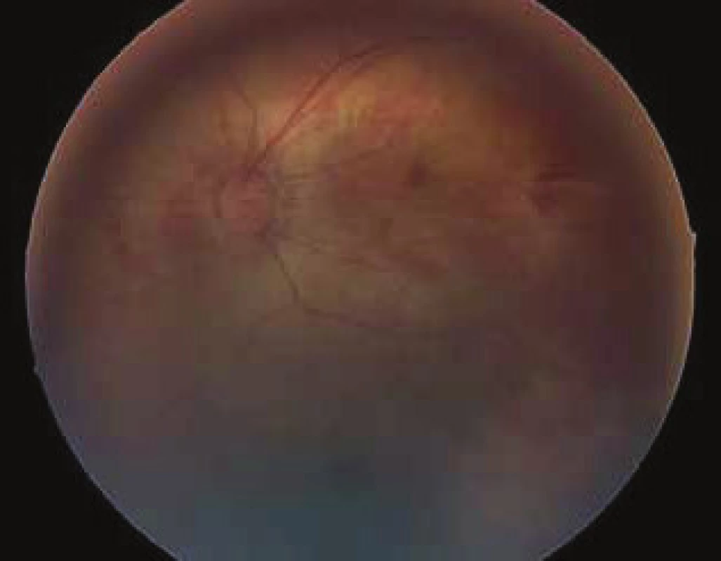 Ocular fundus in patient with Marshall/Stickler syndrome,
right eye. For description see table no. 2.