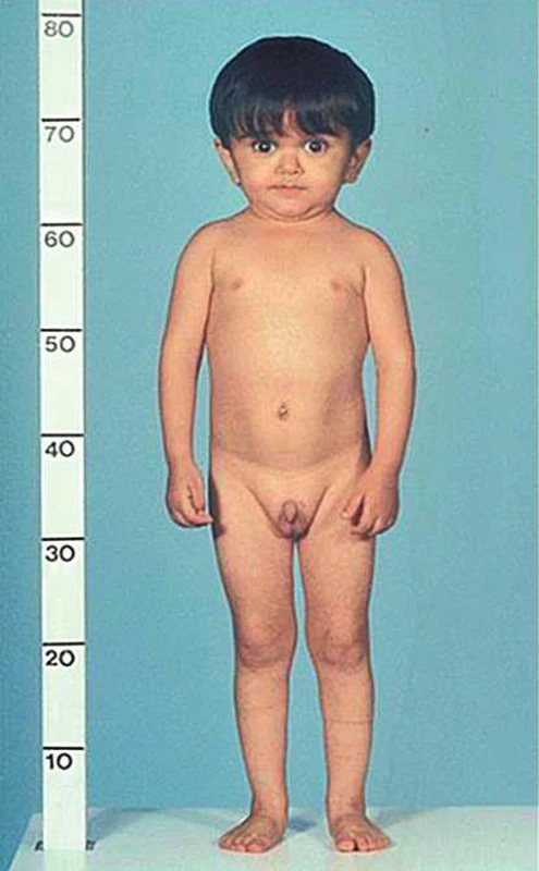 Fenotyp chlapce s Laronovým syndromem – homozygotní mutací genu GHR, který kóduje receptor
růstového hormonu. Vedle těžké růstové retardace je
typická trigonocefalie s prominujícím čelem a vpáčeným kořenem nosu (snímek poskytnut laskavostí prof.
M. Savage).<br>
Fig. 2. Phenotype of a boy with Laron syndrome due to a homozygous mutation of GHR gene encoding growth
hormone receptor. Besides of severe growth retardation, he has typical triangular face with prominent forehead and depressed nasal bridge (thanks to courtesy
of Prof. M. Savage).