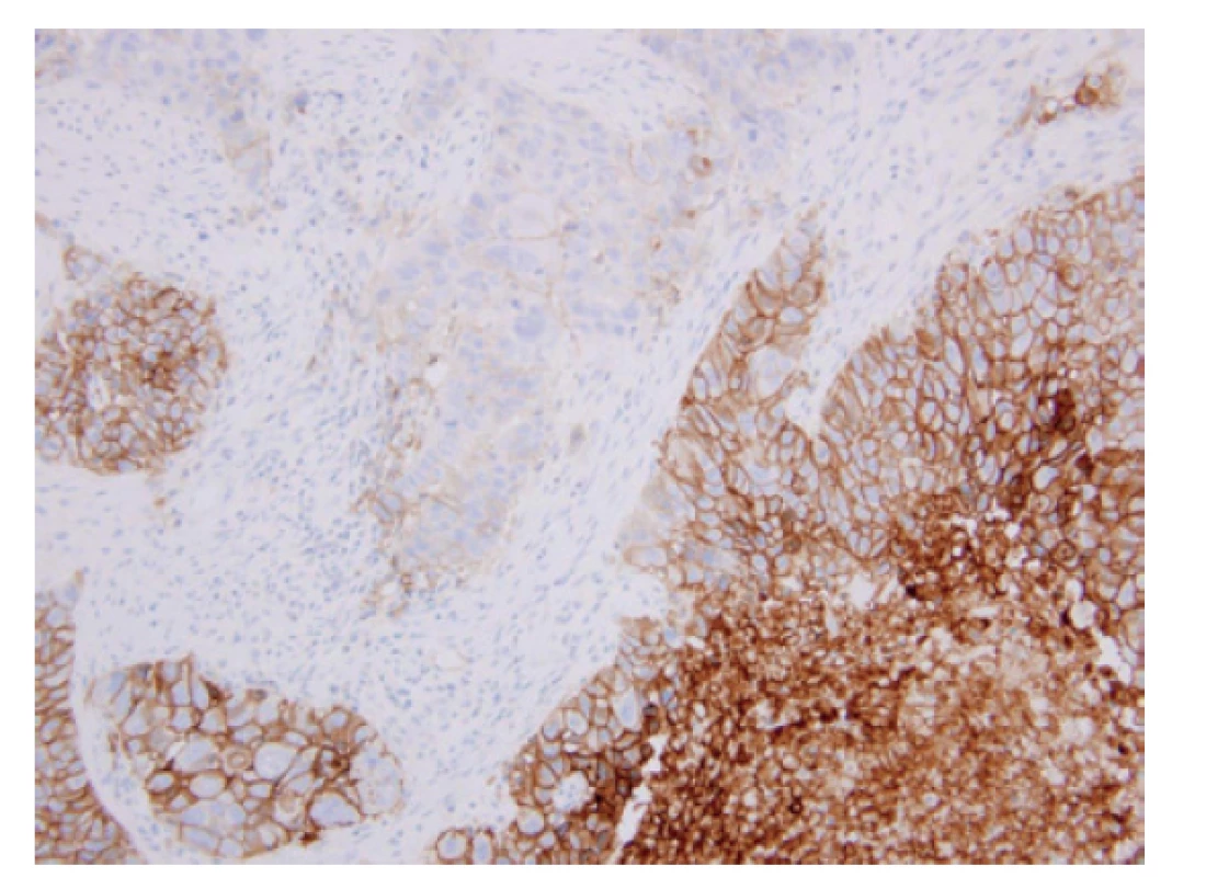 TPS > 50 % (60 %). PD-L1 pozitivní, užit diagnostický kit IHC 22C3
pharmDx (Agilent). Původní zvětšení 200x.
