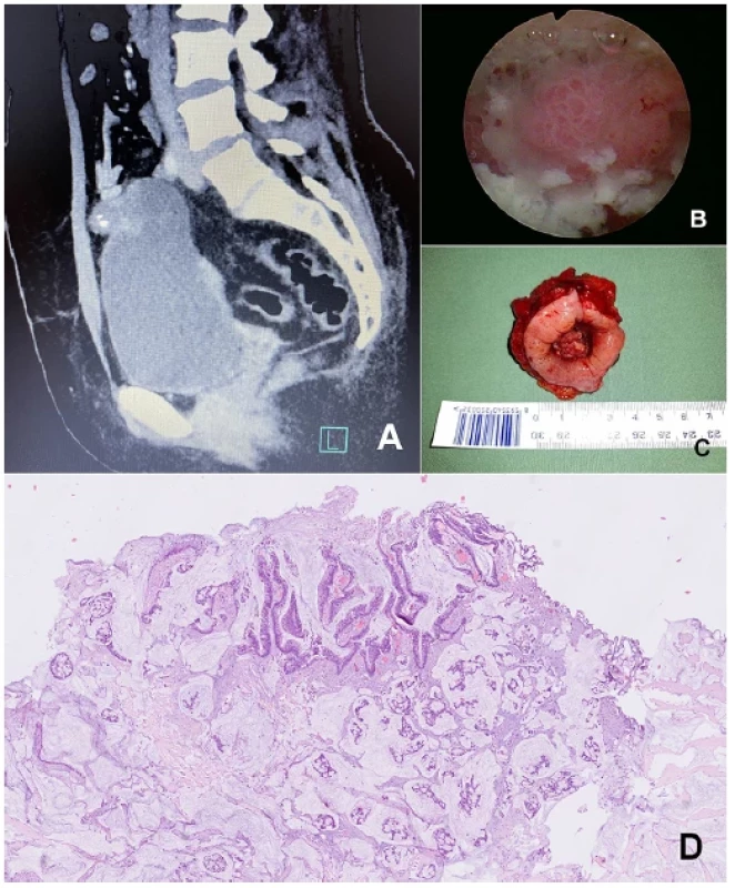 Urachální non-cystický mucinózní (koloidní) adenokarcinom na CT (A), při cystoskopickém vyšetření (B),
resekát tumoru (C) a histologický nález – barveno hematoxylin-eosinem (D) <br> 
Fig. 2. Urachal non-cystic mucinous (colloid) adenocarcinoma on computer tomography (A), during cystoscopic
examination (B) macroscopic specimen after resection (C) and histological appearance of the tumour, staining
hematoxylin-eosin (D)