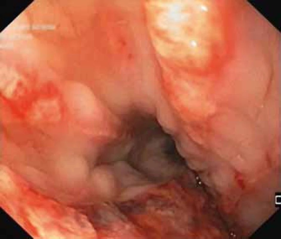 Endoskopický obraz
přetrvávající těžké ezofagitidy
s kontaktním krvácením.<br>
Fig. 2. Endoscopic image of persistent
severe oesophagitis with contact
bleeding.