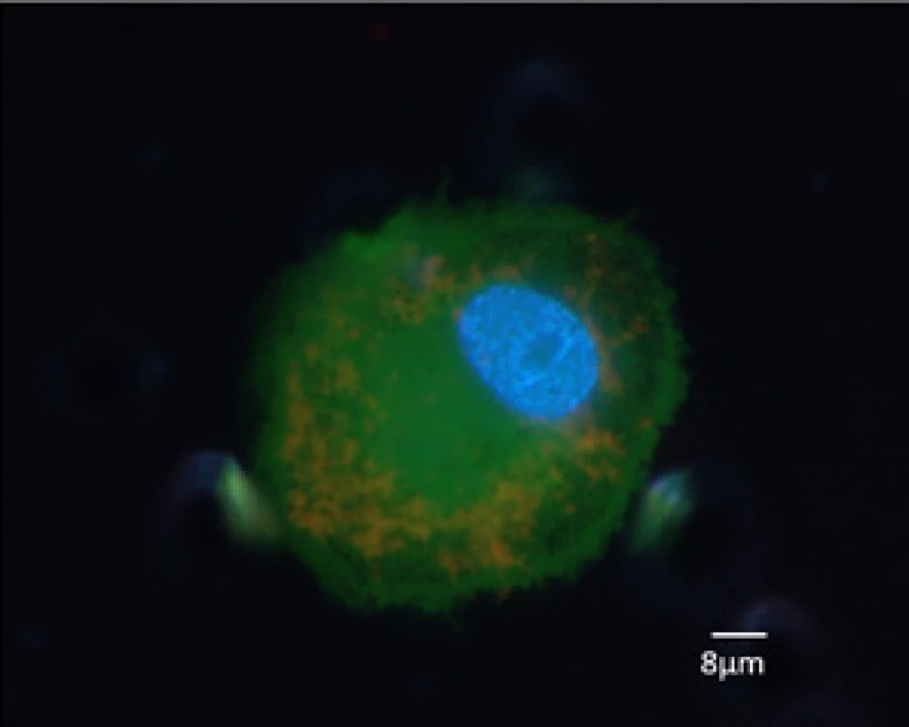 Cirkulující nádorová
buňka od pacienta s karcinomem ledviny po separaci, pětidenní in vitro kultivaci a fluorescenčním barvení, obraz
z fluorescenčního mikroskopu <br>
Fig. 2. A circulating tumour
cell from a patient with renal
cell carcinoma after separation, a five-day in vitro culture,
and fluorescent staining; a fluorescence-microscope image
