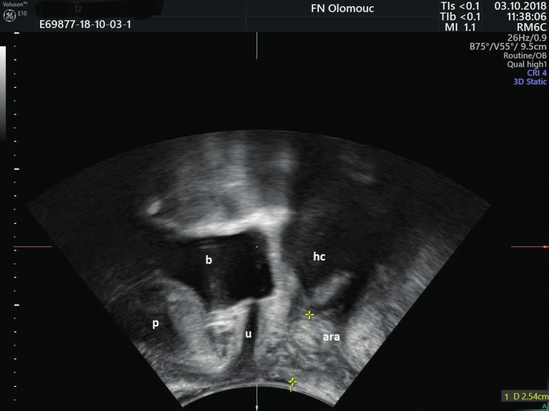Ultrazvukový snímek malé pánve snímaný konvexní
abdominální sondou z perineálního přístupu – měření vzdálenosti
distálního pólu hematokolpos a perinea
b – močový měchýř, u – uretra, p – symfýza, ara – anorektální úhel,
hc – hematokolpos