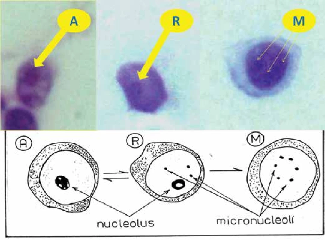 Schema of nucleolar test (NT) A – activated lymphocytes, R – lymphocytes with ring
nucleolus, M – lymphocytes only with micronucleoli, enlarged (1000x) from perspective of
illustration