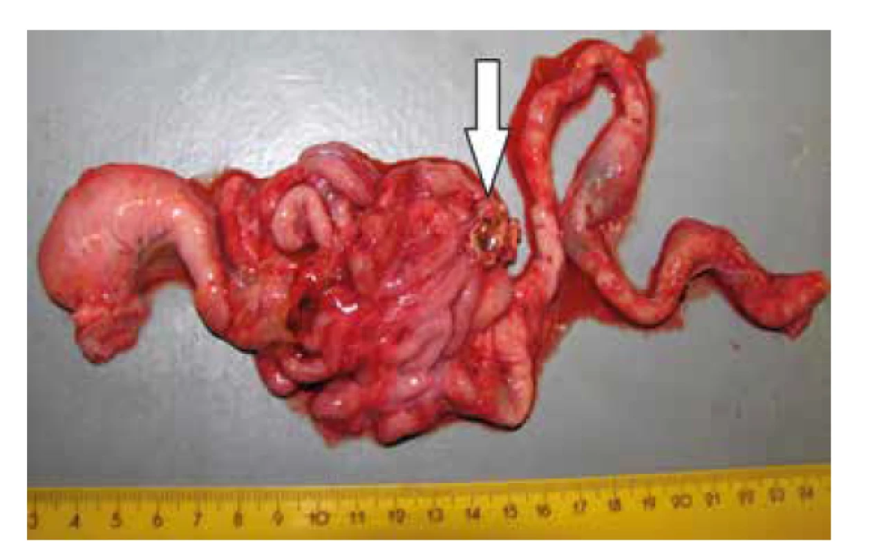 Vypreparovaný gastrointestinálny trakt s s tumoriformným útvarom
v oblasti ilea (šípka).