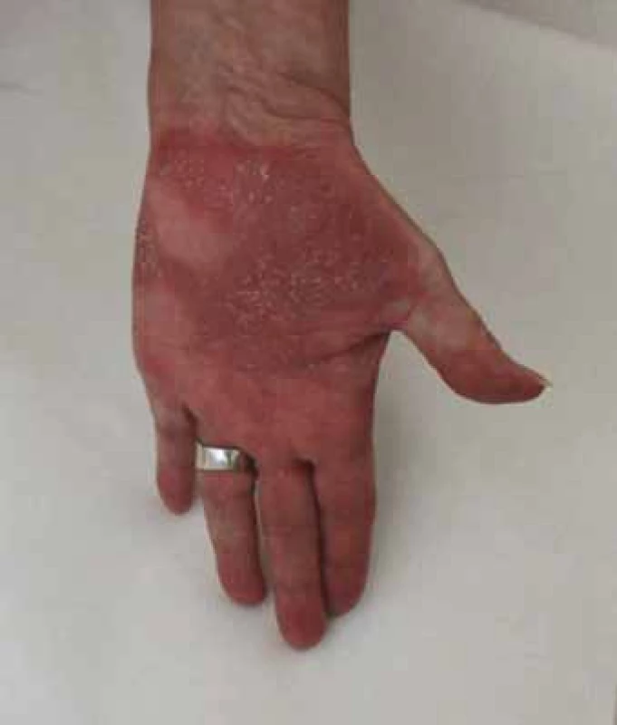 Kompletná regresia aj prejavov
palmoplantárnej pustulózy
12. 6. 2018.<br>
Fig. 4. Complete regression and manifestations
of palmoplantar pustulosis
12th of June 2018.