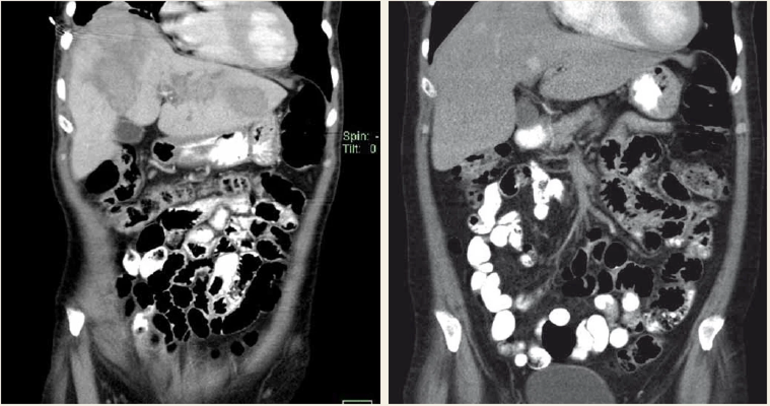 CT vyšetření – aktinomykóza jater kompletně vyléčená 6měsíční terapií klindamycinem.<br>
Fig. 2. CT scan – hepatic actinomycosis completely cured with 6 months’ clindamycin therapy