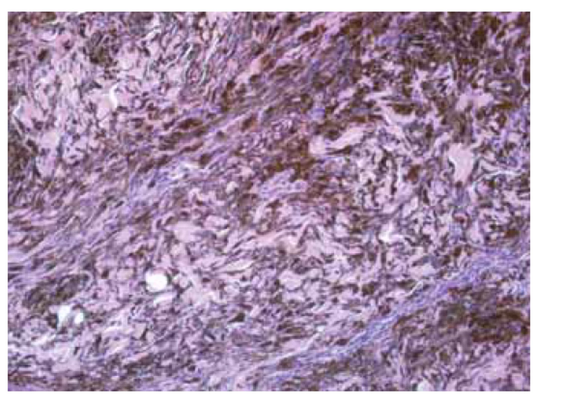 Modrý névus.<br>
Fig. 2. Blue nevus.