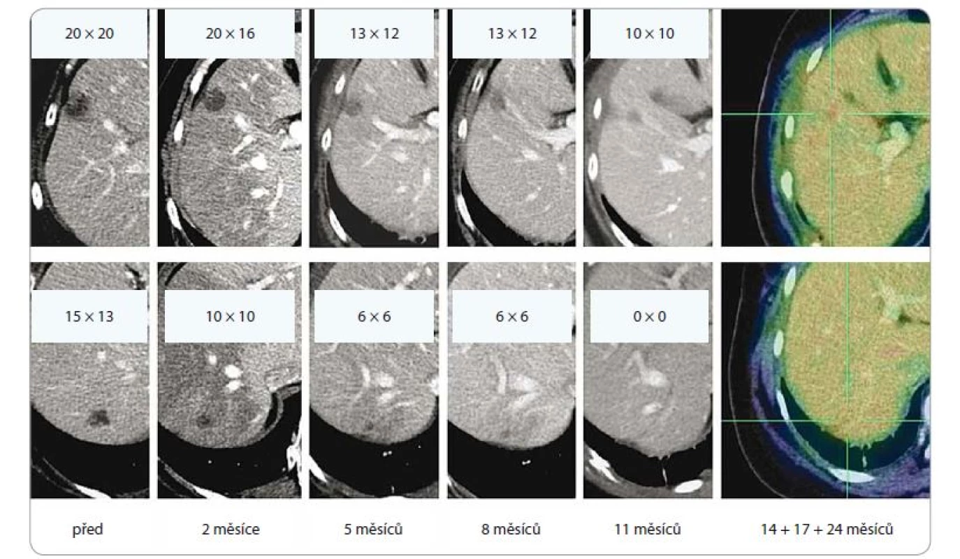Efekt ozáření dvou jaterních metastáz lobulárního karcinomu levého prsu, dávka 3 × 18 Gy, předpis do mediánu dávky v PTV
(PTV 51,7 ccm, D min. 48,7 Gy, D max. 56,6 Gy). Patrná postupná regrese obou ložisek, vznik a ústup postradiační reakce v jaterním
parenchymu. Poslední obrázek v řadě ilustruje stacionární nález ve 14., 17. a 24. měsíci sledování.<br>
PTV – plánovací cílový objem, D – dávka záření, Gy – Gray