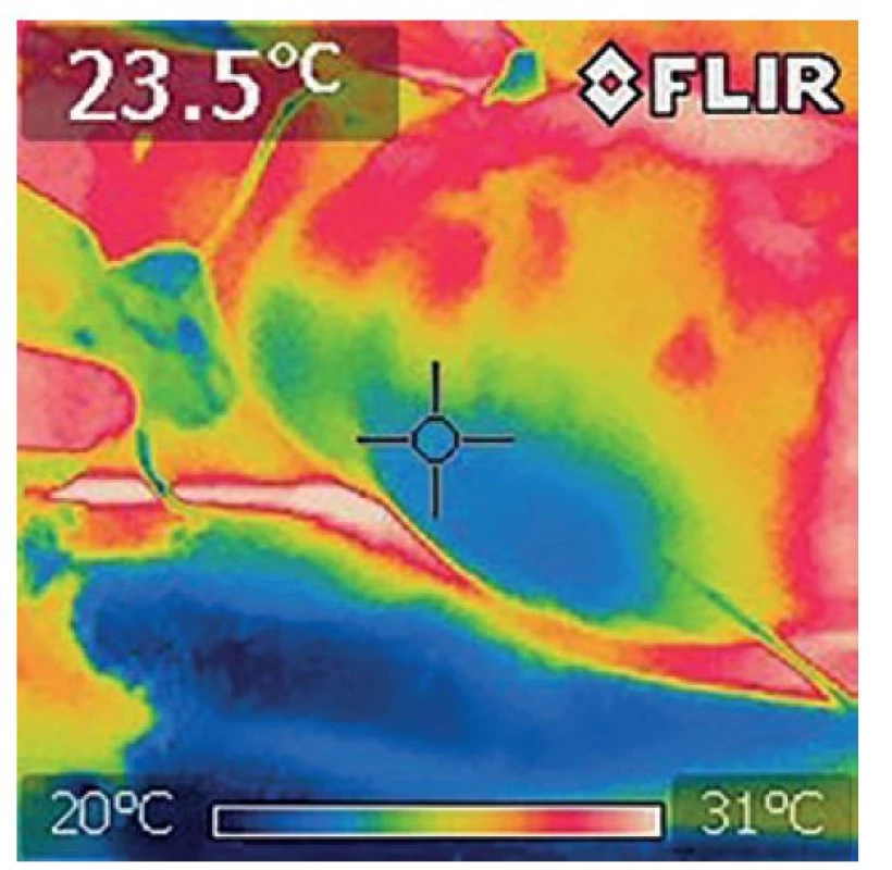 U povrchového průběhu sapheny během expoxice
laseru nejsou známky zvýšené tepoty<br>
Fig. 2: No signs of warming of superficial saphenous vein
during laser exposure