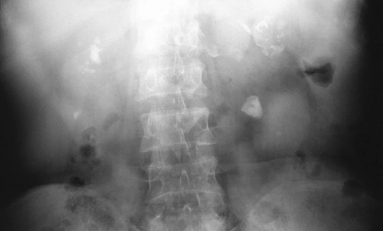 Nativní nefrogram: TB
kalcifikace obou ledvin<br>
Fig. 5. Plain x-ray KUB: TB calcifications
in both kidneys