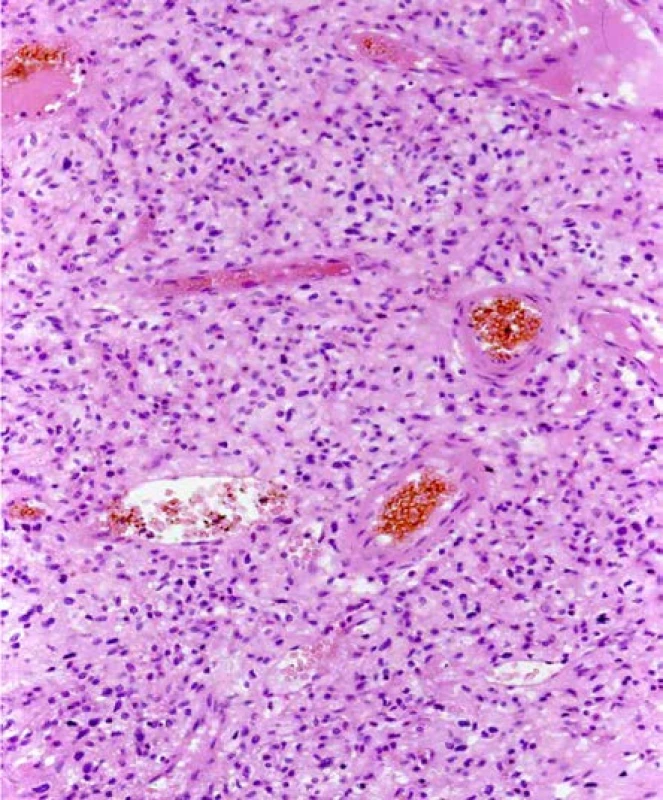 Světlobuněčný renální karcinom u pacienta
s VHL syndromem. Barveno HE. Zvětšeno 400×<br>
Fig. 5. Clear cell renal cell carcinoma, patient with a VHL
syndrome. H&E. Viewed at 400× magnification